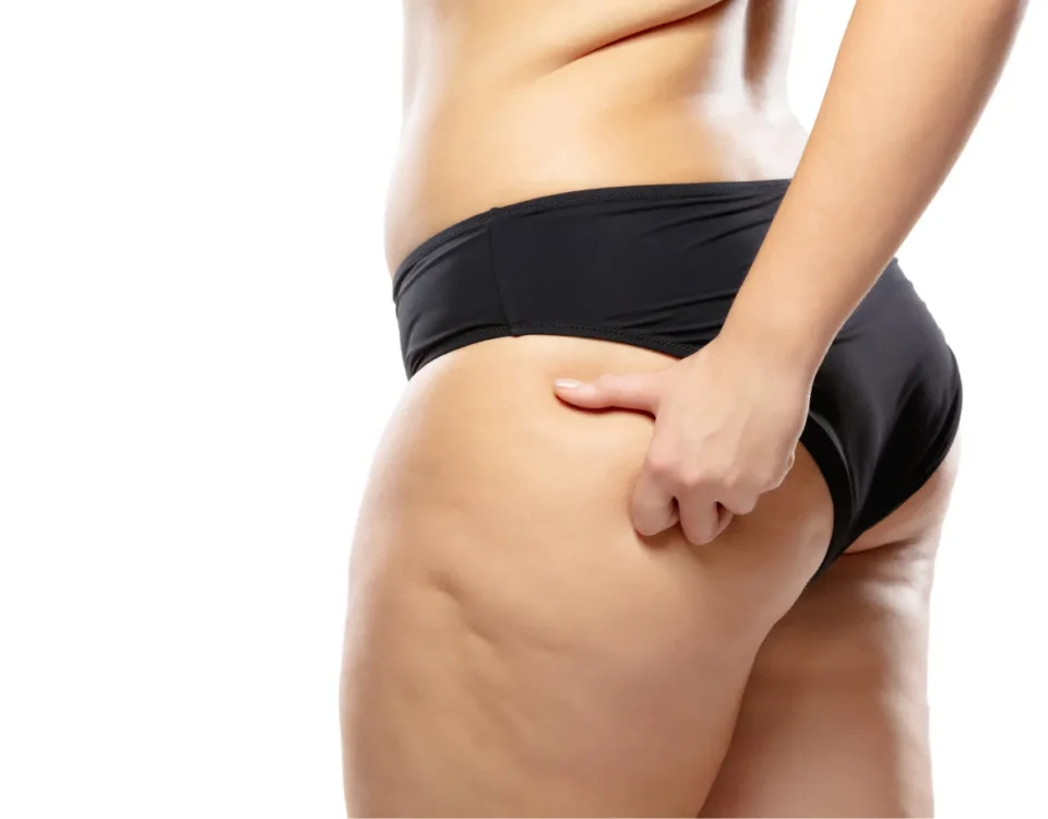 Liposuccion du lipœdème