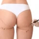 Liposuccion sous-fessière en Tunisie
