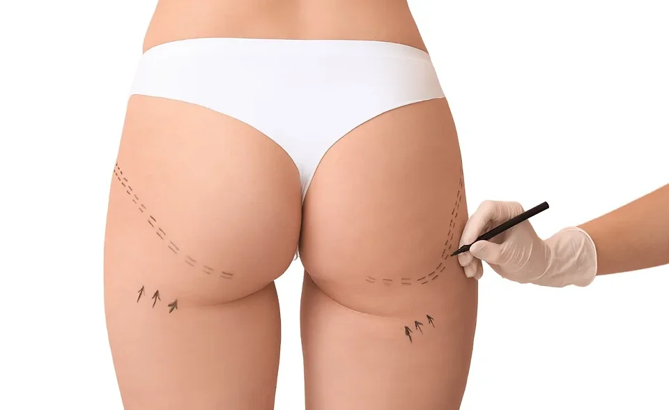 Liposuccion sous-fessière en Tunisie