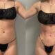 Rib Remodeling et liposuccion 360°