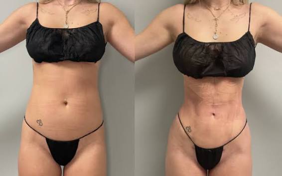 Rib Remodeling et liposuccion 360°